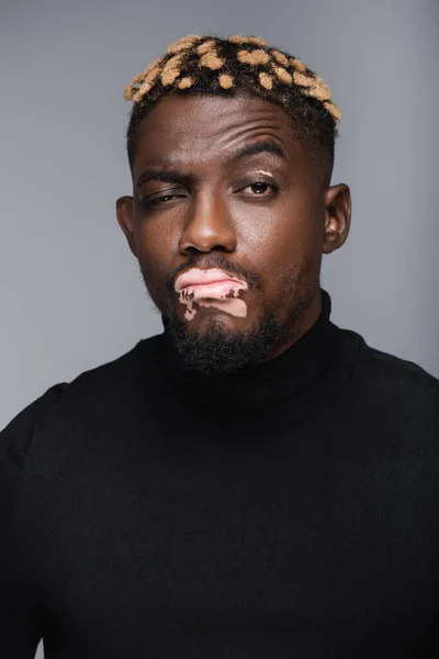 Pensive african american man with vitiligo and trendy hairstyle looking at camera isolated on grey — Foto stock