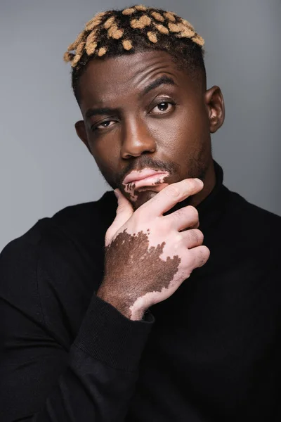 Pensive african american man with vitiligo touching chin and looking at camera isolated on grey — Foto stock