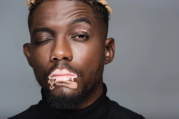 Close up portrait of african american man with vitiligo and one closed eye looking at camera isolated on grey — Photo de stock