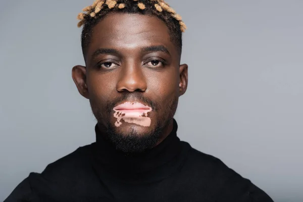 Young african american man with vitiligo, wearing black turtleneck, looking at camera isolated on grey — Stock Photo