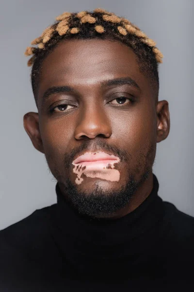 Primer plano retrato de hombre joven afroamericano con vitiligo y peinado de moda aislado en gris - foto de stock