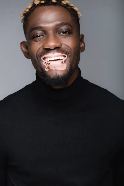 Hombre afroamericano feliz con vitiligo sonriendo a la cámara aislado en gris - foto de stock