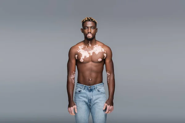 Без сорочки і м'язистий афроамериканський чоловік зі шкірою вітіліго дивиться на камеру ізольовано на сірому — стокове фото