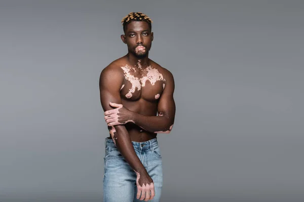 Без сорочки афроамериканський чоловік зі шкірою вітіліго і м'язистим торсом позує ізольовано на сірому — стокове фото