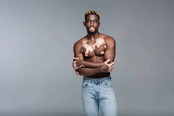 Shirtless african american man with vitiligo skin posing with crossed arms isolated on grey — Stock Photo