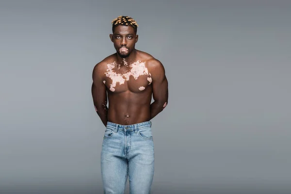 Young african american man with vitiligo skin and muscular torso holding hands behind back while posing in jeans isolated on grey — Stockfoto