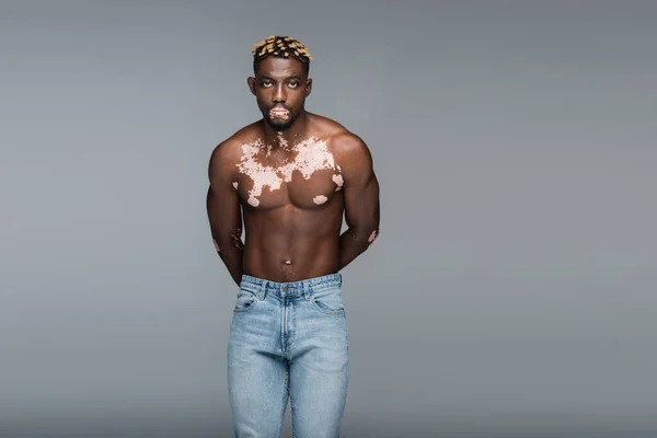 Young african american man with vitiligo skin and muscular torso holding hands behind back while posing in jeans isolated on grey — Stock Photo