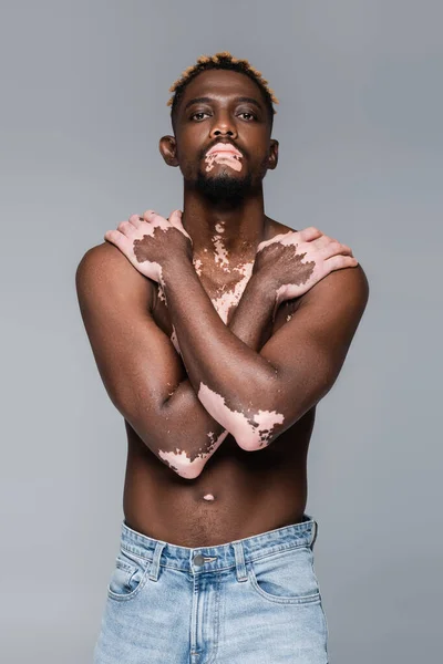Young african american man with vitiligo and shirtess muscular torso covering chest with hands isolated on grey — Stock Photo