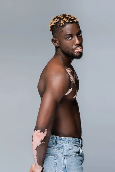 Young and shirtless african american man with vitiligo standing with hand behind back isolated on grey — Stockfoto