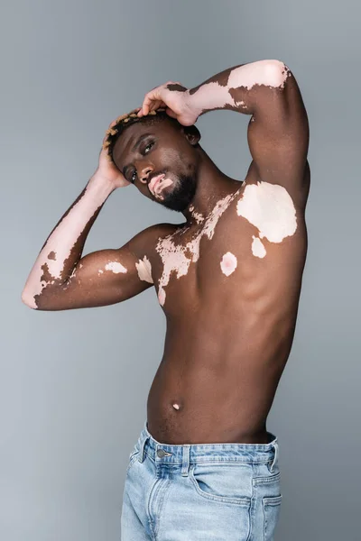 Без сорочки афроамериканський чоловік з вітіліго дивиться на камеру, позує руками на голову ізольовано на сірому — стокове фото