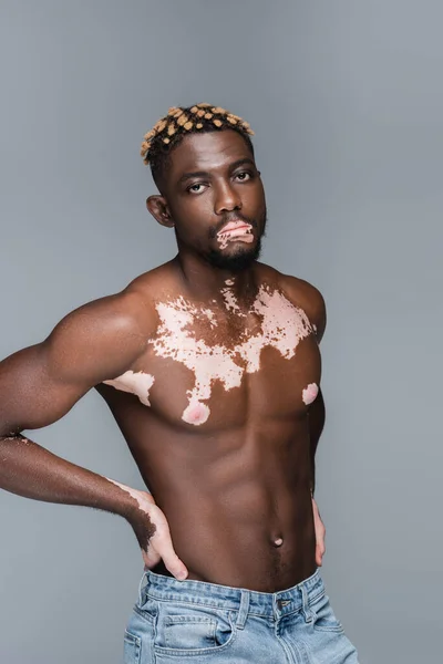 Young and muscular african american man with vitiligo skin posing with hands on waist isolated on grey — Foto stock