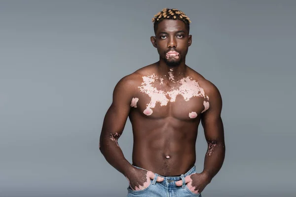 Hombre afroamericano sin camisa con piel de vitiligo posando con las manos en bolsillos de jeans aislados en gris - foto de stock