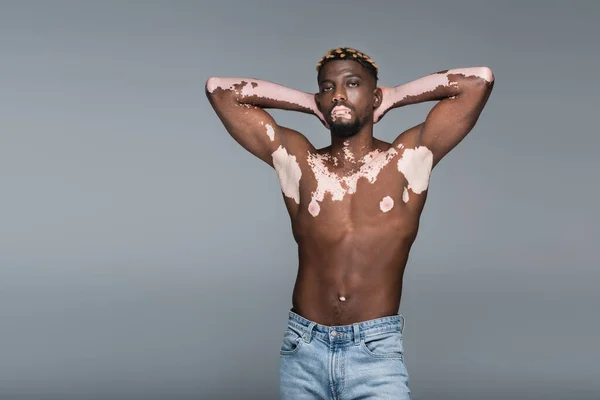 Shirtless african american man with vitiligo skin and muscular torso posing with hands behind head isolated on grey — Stock Photo
