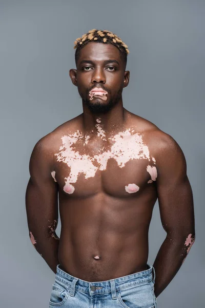 Shirtless african american man with vitiligo standing with hands behind back and looking at camera isolated on grey - foto de stock