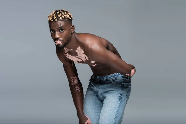 Без сорочки афроамериканський чоловік зі шкірою вітіліго дивиться на камеру, позує в джинсах ізольовано на сірому — стокове фото