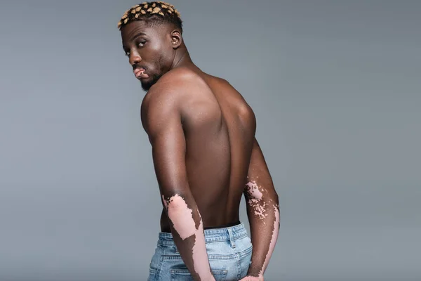 Africano americano hombre con vitiligo piel posando sin camisa aislado en gris - foto de stock