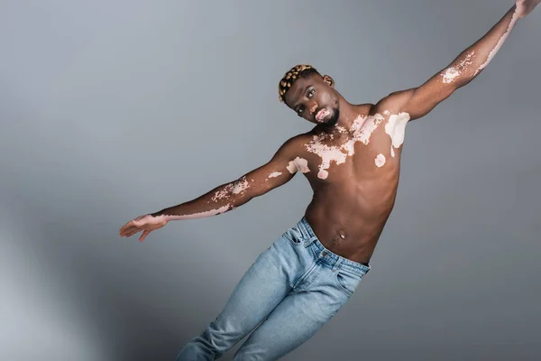 Hombre afroamericano sin camisa con vitiligo y peinado de moda posando con las manos extendidas aisladas en gris - foto de stock