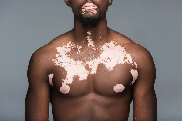 Обрізаний вид без сорочки афроамериканця з шкірою вітіліго та м'язовим торсом ізольовано на сірому — стокове фото