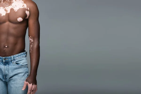 Vista recortada de hombre afroamericano sin camisa con piel de vitiligo de pie en jeans aislados en gris - foto de stock