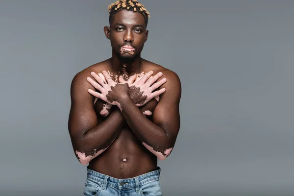 Shirtless african american man with vitiligo skin covering chest with hands isolated on grey — стоковое фото