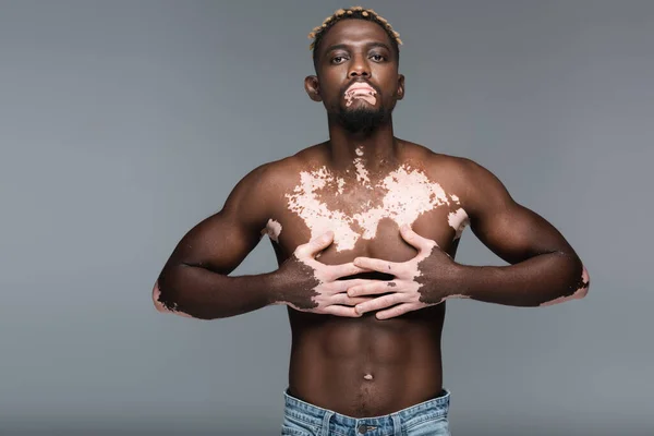 Hombre afroamericano musculoso con vitiligo de pie con las manos en el pecho y mirando a la cámara aislada en gris - foto de stock