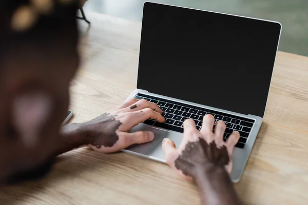 Partial view of blurred african american man with vitiligo typing on laptop with blank screen in office — Photo de stock