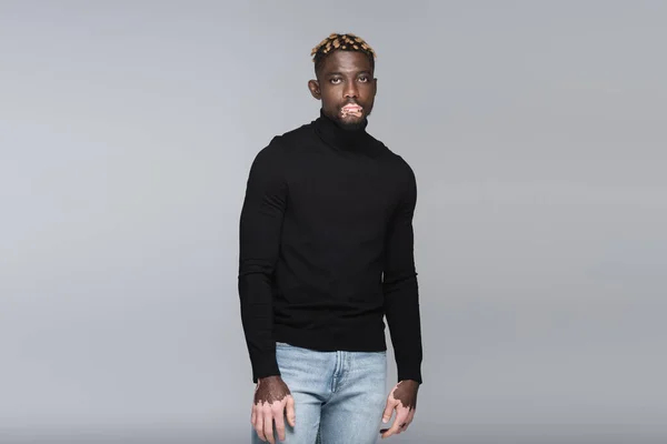 Trendy african american man with vitiligo posing in black turtleneck and jeans isolated on grey - foto de stock