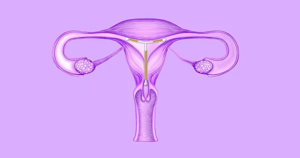 Sistema Reproductor Femenino Con Dispositivo Intrauterino Dentro Ilustración Órganos Femeninos —  Fotos de Stock