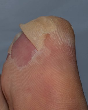 Kafkasyalı yetişkin bir adamda kızıl hastalığı