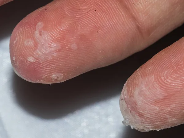 Detalhe Esfoliação Após Escarlatina Adulto Caucasiano — Fotografia de Stock