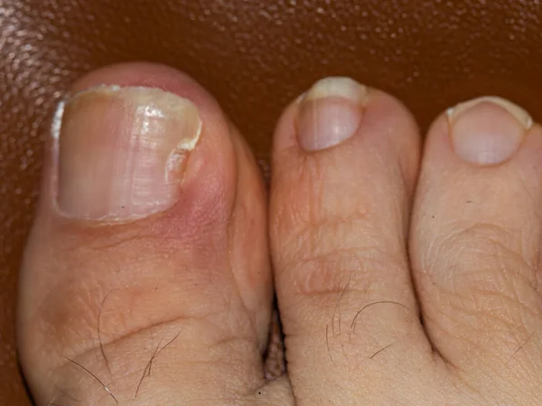 big toe with nail problem