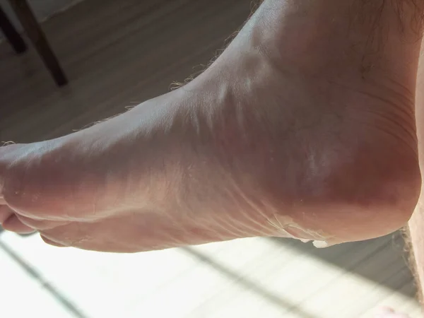 Close Male Foot Peeling Skin Avitaminosis Disease Dry Problematic Skin — Photo