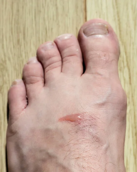 A blister on the top of a mans foot