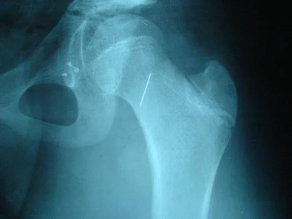 X-ray Orthopedics , accident.* The syringe needle was broken during injection.* Notice the needle on the head\'s thigh bone.* X ray image of the human head\'s thigh bone