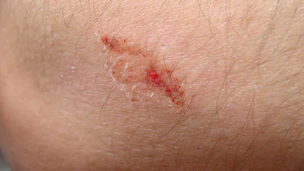 Herida Excoriación Brazo Herida Ocurrió Mientras Iba Bici Cicatrización Heridas — Foto de Stock