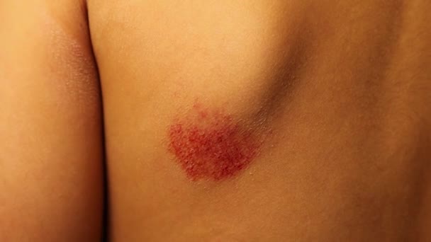 Blessure Par Excoriation Chez Jeune Garçon Sur Dos Sous Omoplate — Video