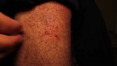 İyileşme evresinde bir yarayı ovalamak, kanamaya neden olur. Kabuk bağlama aşamasında (yara iyileşme) kişi yara bölgesinde kaşıntı hisseder, alerjisi vardır. Eğitici, Tıp