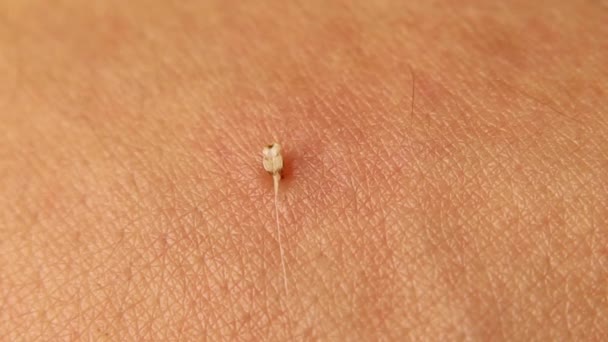 Bienengiftbeutel Honigbiene Sticht Einem Mann Den Arm Wenn Der Stich — Stockvideo