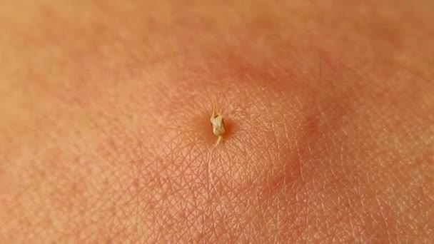 Bienengiftbeutel Honigbiene Sticht Einem Mann Den Arm Wenn Der Stich — Stockvideo