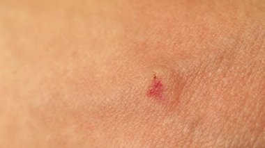 Bir adamın kolunda arı sokması. İşçi arı tarafından sokulmuş. Cilt alerjisi, alerji. Bal arısı sokması tedavisi. Yakından bal arısı elini sokuyor. Böcekler, böcekler, hayvanlar, vahşi yaşam, vahşi doğa.