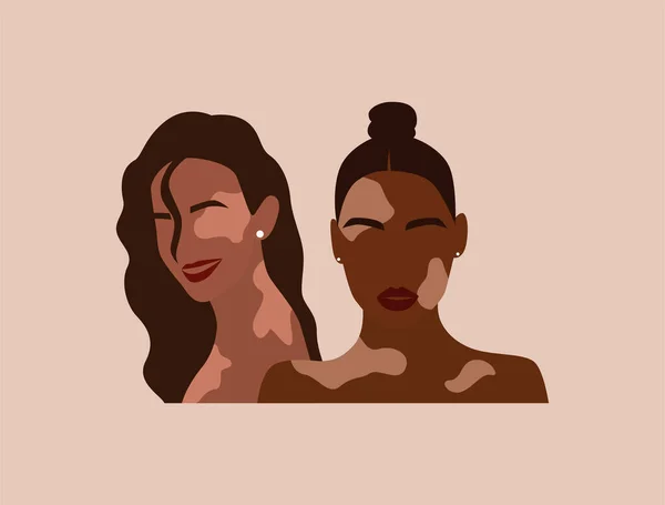 Deux femmes avec vitiligo de nationalités différentes ensemble.Potrait abstrait sans visage de la femme. Pigmentation dermatologie maladie concept. Illustration vectorielle plate moderne — Image vectorielle