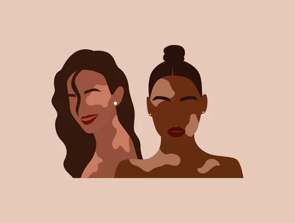 Dos mujeres con vitiligo de diferentes nacionalidades juntas. Retrato abstracto sin rostro de mujer. Concepto de enfermedad dermatológica por pigmentación. Moderna ilustración vectorial plana — Archivo Imágenes Vectoriales