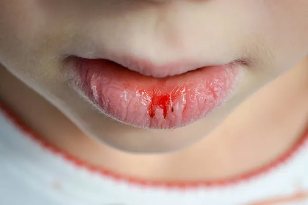 Dry Damaged Lips Girl Close Lip Fissure Bleeding Sick Cracked — Stock Photo, Image