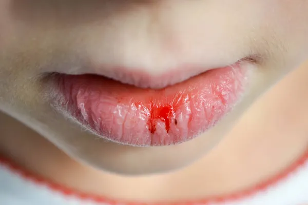 Lábios Secos Danificados Uma Menina Close Fissura Labial Hemorragia Doente — Fotografia de Stock