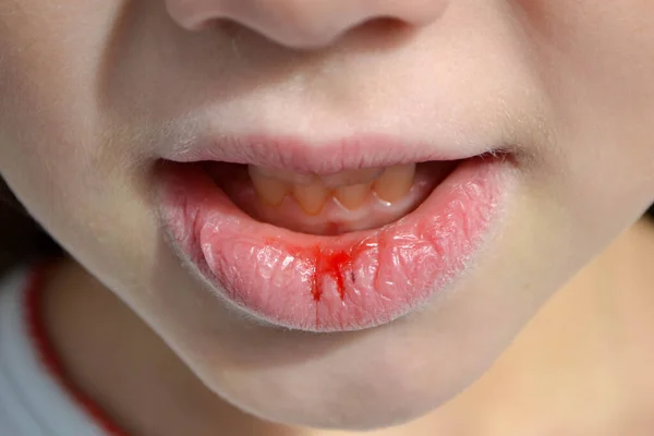 Dry Damaged Lips Girl Close Lip Fissure Bleeding Sick Cracked — Stock Photo, Image