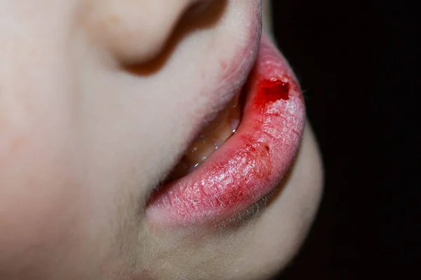 一个女孩干裂的嘴唇 唇裂和流血 病坏了的组织 干唇有裂缝 口干舌燥 口干舌燥 口干舌燥 脱水高质量照片 — 图库照片