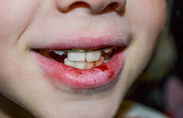 Trockene Und Beschädigte Lippen Eines Mädchens Nahaufnahme Lippenrisse Und Blutungen — Stockfoto