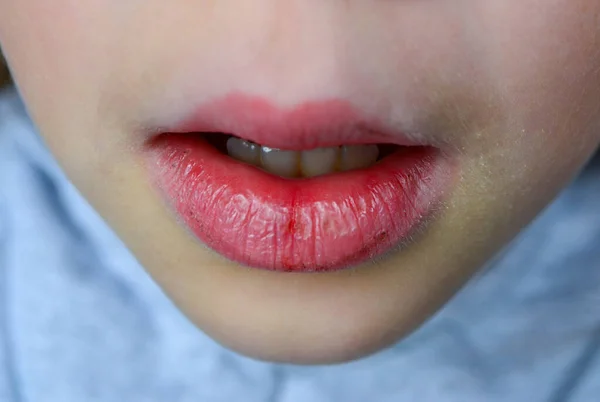 Suche Zniszczone Usta Dziewczyny Zbliżenie Szczelina Ustach Krwawienie Chorą Uszkodzoną — Zdjęcie stockowe