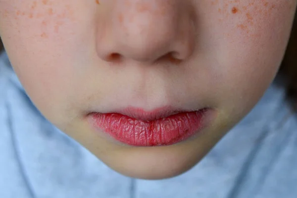 Dry Damaged Lips Girl Close Lip Fissure Bleeding Sick Cracked — Stock Photo, Image