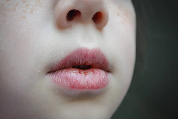 Dry Damaged Lips Girl Close Lip Fissure Bleeding Sick Cracked — Stock Photo, Image